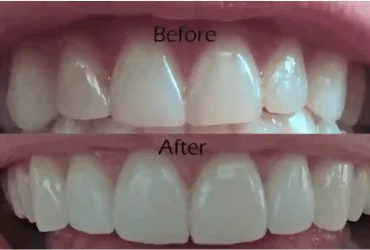 The Advantages of Holistic Cosmetic Dentistry Over Conventional Cosmetic Dentistry